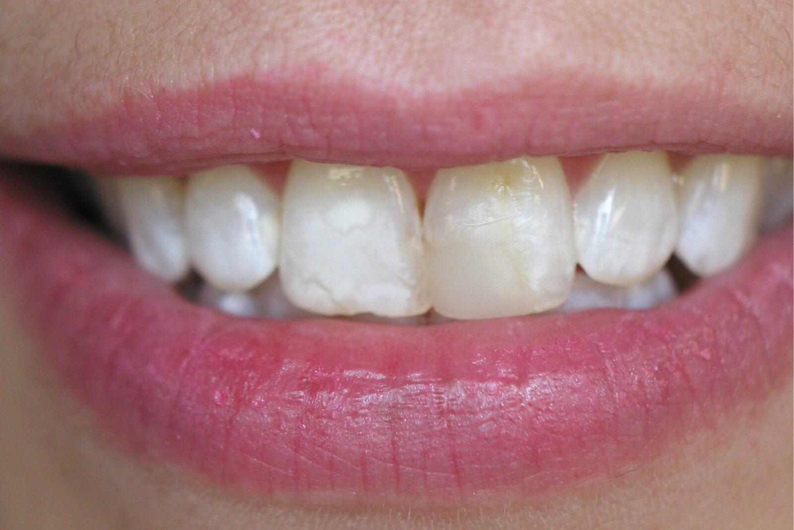 Client's teeth before treatment