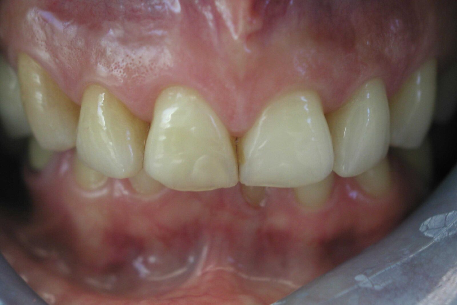 Client's teeth before treatment