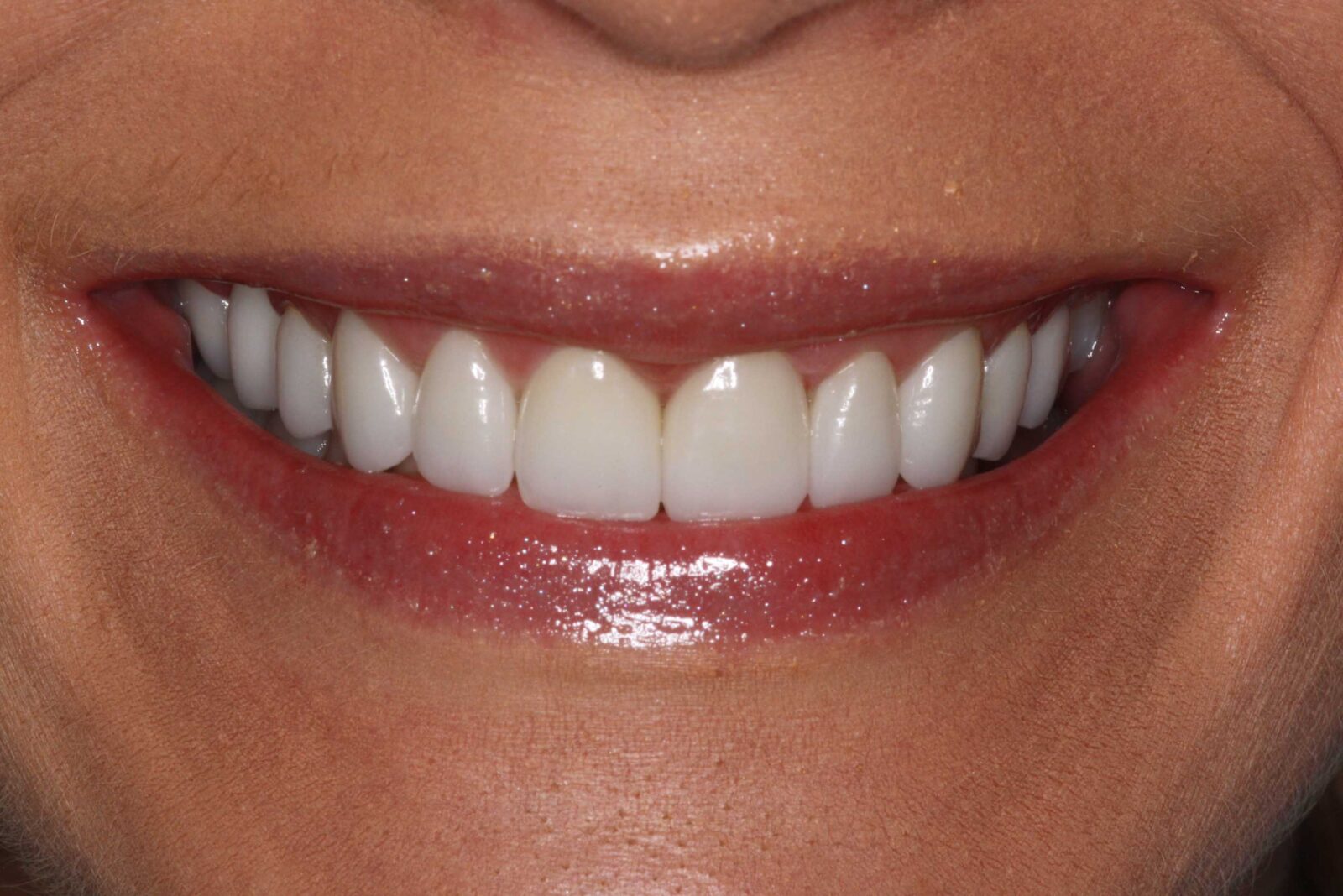 Client's teeth after treatment