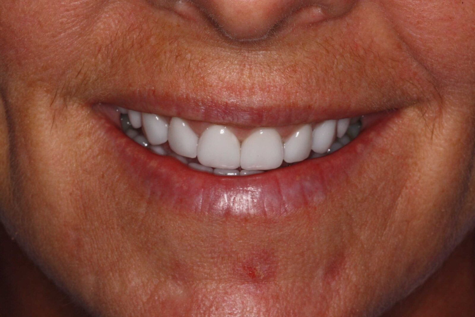 Client's teeth after treatment