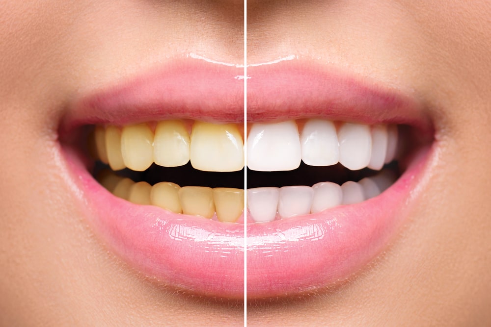 Woman Teeth Before and After Whitening