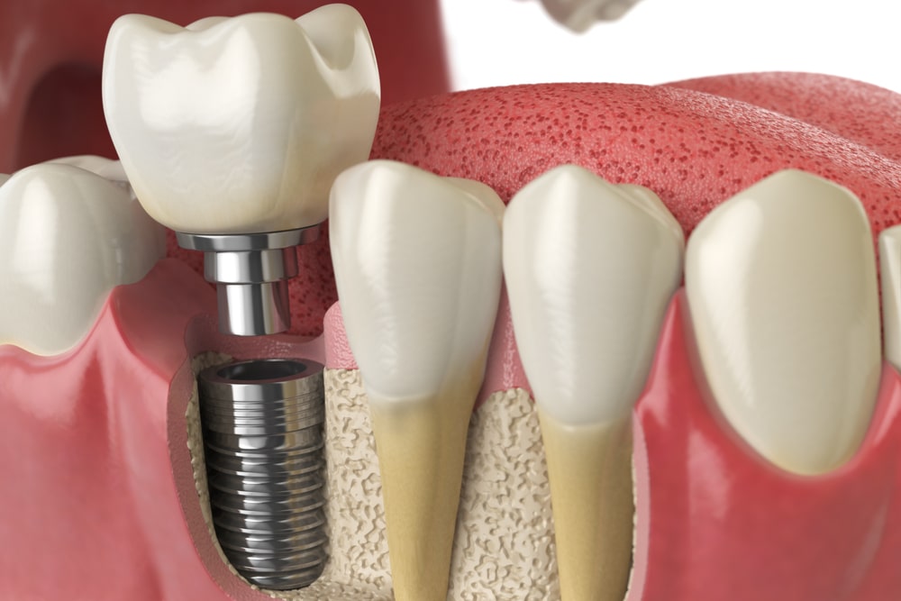 Anatomy of healthy teeth and tooth dental implant