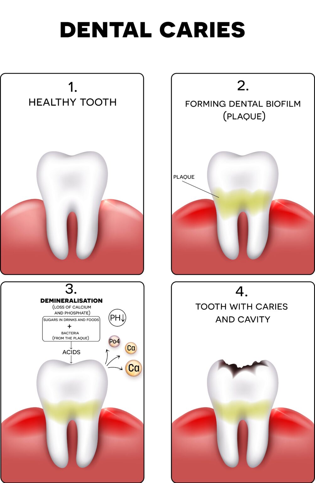 cavities-the-detailed-guide-mclean-va-smile-mclean-dentistry