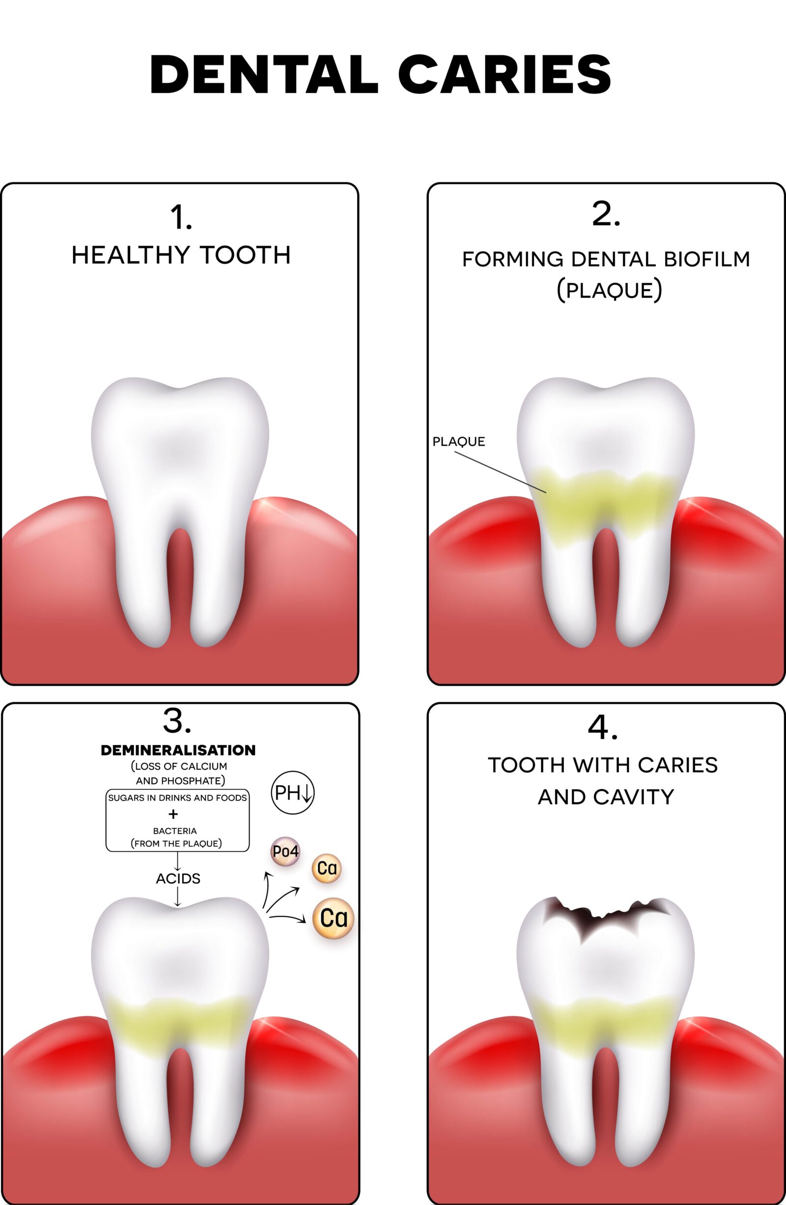 stages of a cavity forming