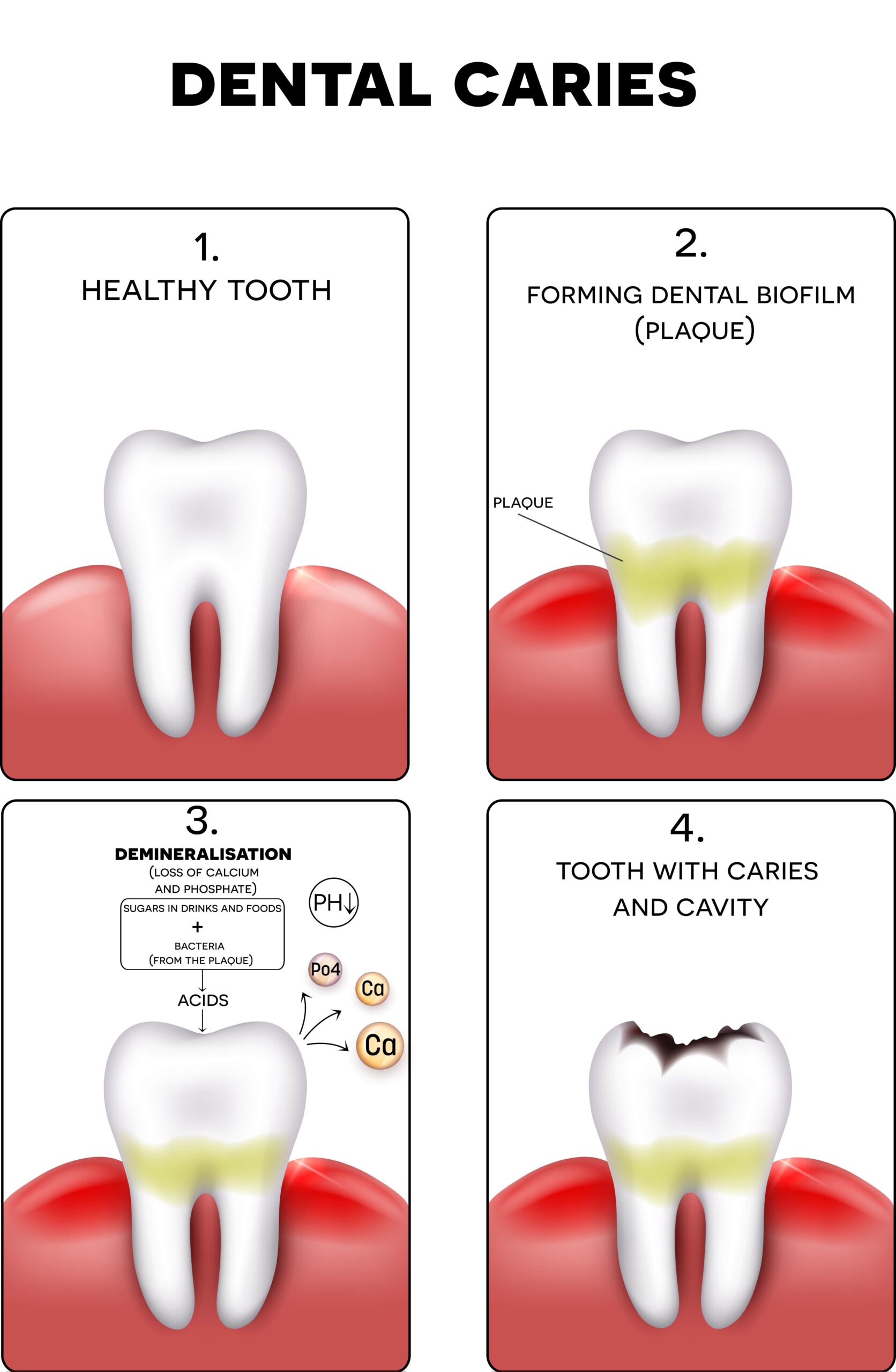 Cavities The Detailed Guide Mclean Va Smile Mclean Dentistry 4994