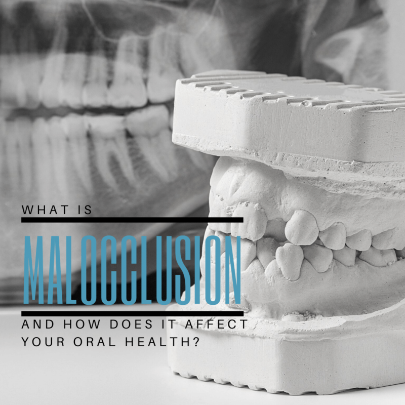What is malocclusion