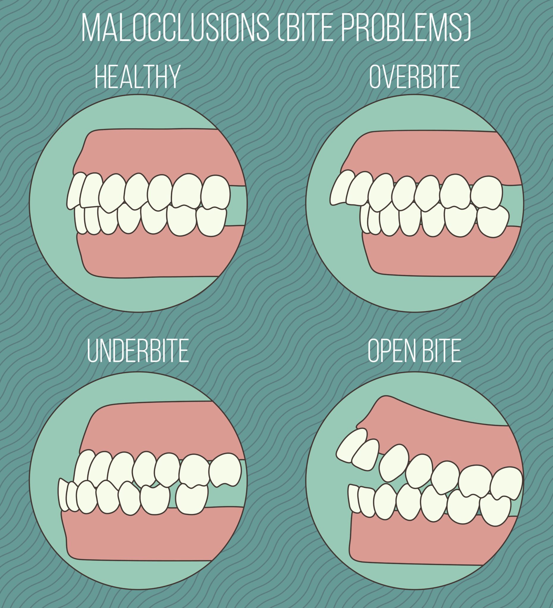 What Is Malocclusion And How Does It Affect Your Oral Health? | McLean ...