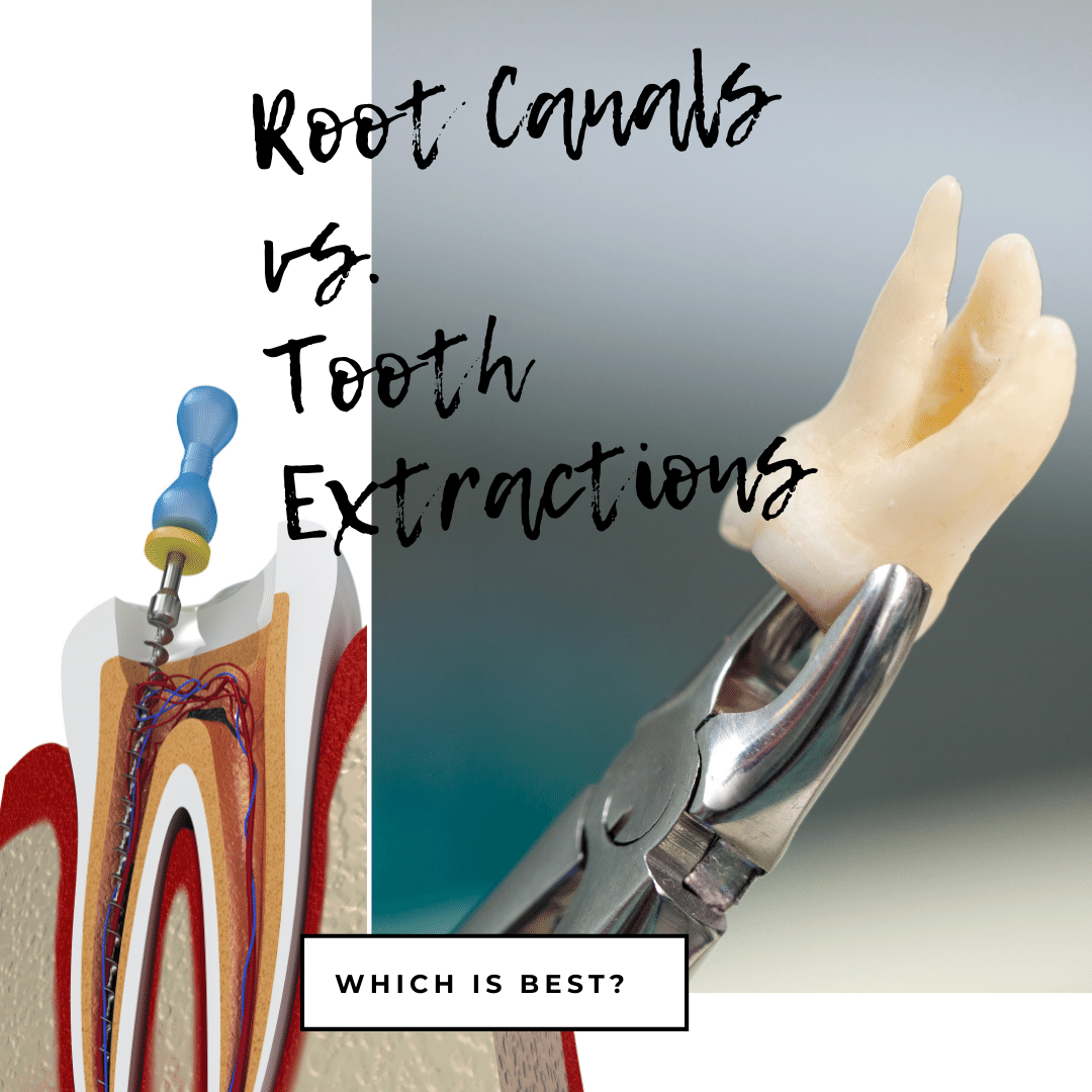 Root Canals vs. Tooth Extractions
