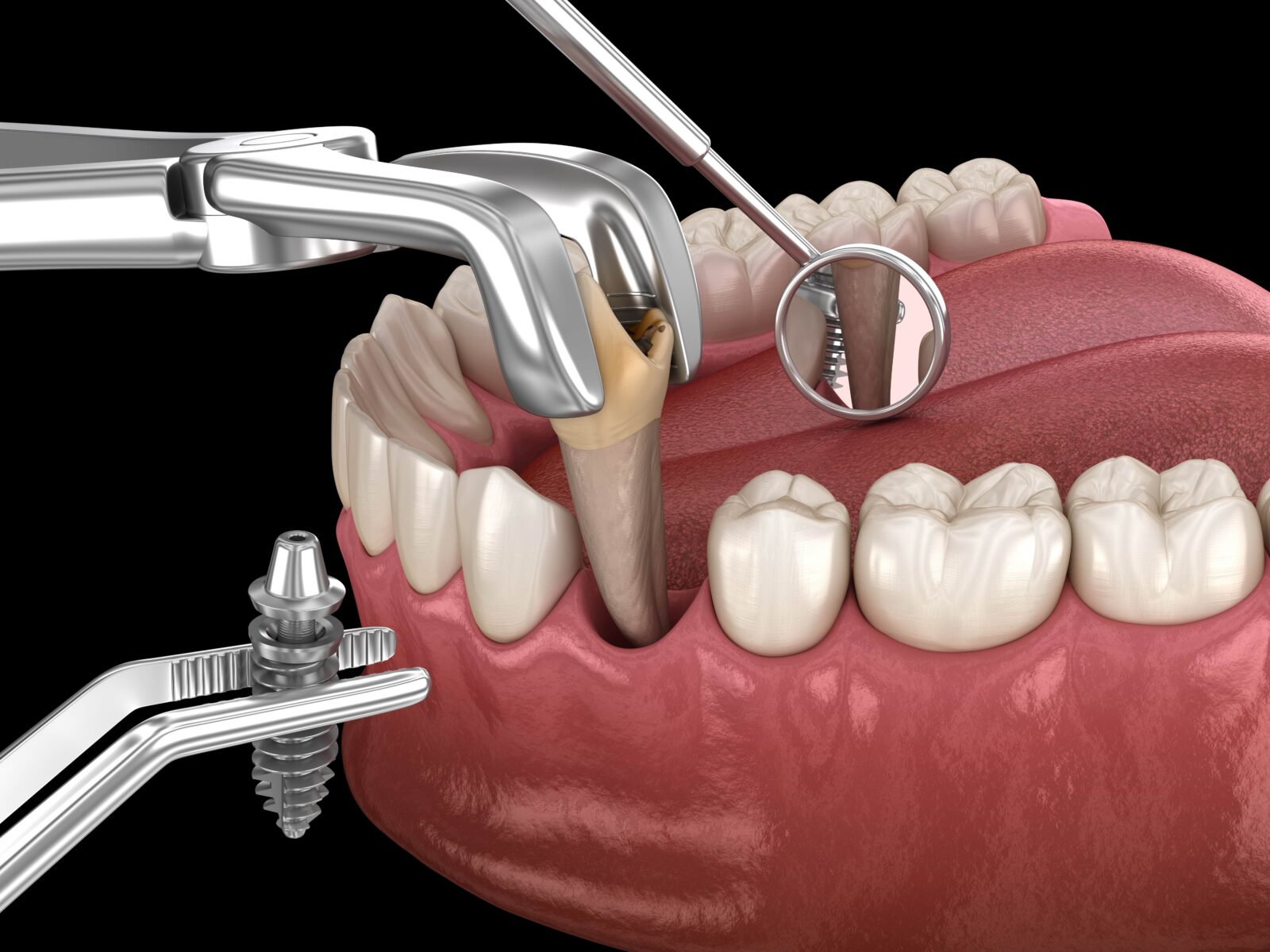 tooth extraction with dental implant replacement