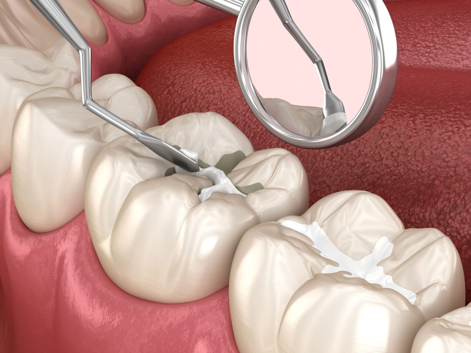 composite filling being placed in tooth
